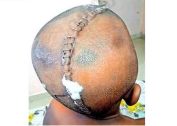 ദലിത് ബാലനെ അധ്യാപകൻ ചൂരൽ കൊണ്ടു പലതവണ ക്രൂരമായി തലയ്ക്കടിച്ചു..!! തലയോട്ടിക്കും ഞരമ്പുകൾക്കും ഗുരുതര ക്ഷതം. അടിയന്തര ശസ്ത്രക്രിയയ്ക്കു വിധേയനാക്കി…