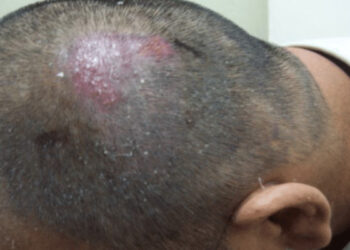 തലയിൽ കൃത്രിമ മുടി വച്ചുപിടിപ്പിച്ചതിന് പിന്നാലെ വേദനയും ചൊറിച്ചിലും, പിന്നീട്  അസഹനീയ തലവേദന,  ഗുരുതര അണുബാധയിൽ വലഞ്ഞ് യുവാവ്