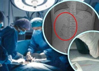 അടിച്ചു പാമ്പായി അബ​ദ്ധത്തിൽ വിഴുങ്ങിയത് സ്പൂൺ, സംഭവം തിരിച്ചറഞ്ഞത് ആറുമാസത്തിനു ശേഷം നടത്തിയ സ്കാനിങ്ങിൽ, ശസ്ത്രക്രിയയിലൂടെ സ്പൂൺ പുറത്തെടുത്തു