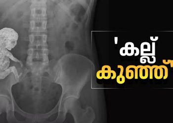 ‘കല്ല് കുഞ്ഞ്’; അമ്മയുടെ ശരീരത്തിൽ കാൽസ്യം നിറഞ്ഞ ‘സ്റ്റോൺ ബേബി’, എക്സ് റേ ചിത്രം പങ്കുവച്ച് ഡോക്ടർ, അമ്പരന്ന് ലോകം