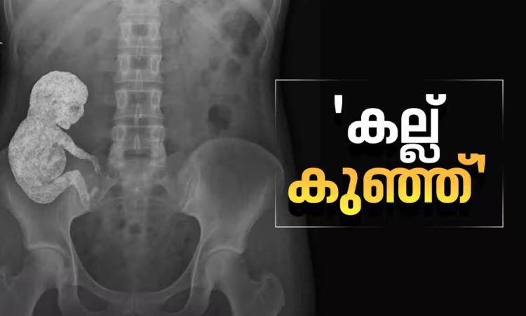 ‘കല്ല് കുഞ്ഞ്’; അമ്മയുടെ ശരീരത്തിൽ കാൽസ്യം നിറഞ്ഞ ‘സ്റ്റോൺ ബേബി’, എക്സ് റേ ചിത്രം പങ്കുവച്ച് ഡോക്ടർ, അമ്പരന്ന് ലോകം