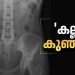 ‘കല്ല് കുഞ്ഞ്’; അമ്മയുടെ ശരീരത്തിൽ കാൽസ്യം നിറഞ്ഞ ‘സ്റ്റോൺ ബേബി’, എക്സ് റേ ചിത്രം പങ്കുവച്ച് ഡോക്ടർ, അമ്പരന്ന് ലോകം