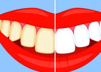 പല്ലുകളിലെ മഞ്ഞ നിറം മാറ്റാന്‍ വീട്ടില്‍ പരീക്ഷിക്കേണ്ട എട്ട് കാര്യങ്ങള്‍