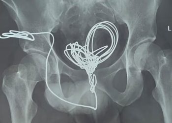 മൂത്രനാളിയിലേക്ക് യുവാവ് കുത്തിക്കയറ്റിയത് മൂന്ന് മീറ്ററോളം ഇലക്ട്രിക് വയർ; പുറത്തെടുത്തത് വയർ തുറന്നുള്ള ശസ്ത്രക്രിയയിലൂടെ