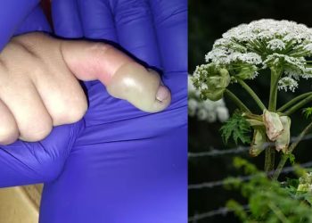 ഡേ കെയറിൽ പോകുന്ന വഴിയിൽ തൊട്ടത് വിഷച്ചെടിയിൽ, 3 വയസുകാരന്റെ വിരലുകൾ പൊള്ളിവീർത്തു