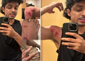 ‘പ്രകമ്പനം’ സിനിമയുടെ ആക്ഷൻ രംഗം ചിത്രീകരിക്കുന്നതിനിടെ നടൻ സാഗർ സൂര്യയ്ക്ക് പരുക്ക്