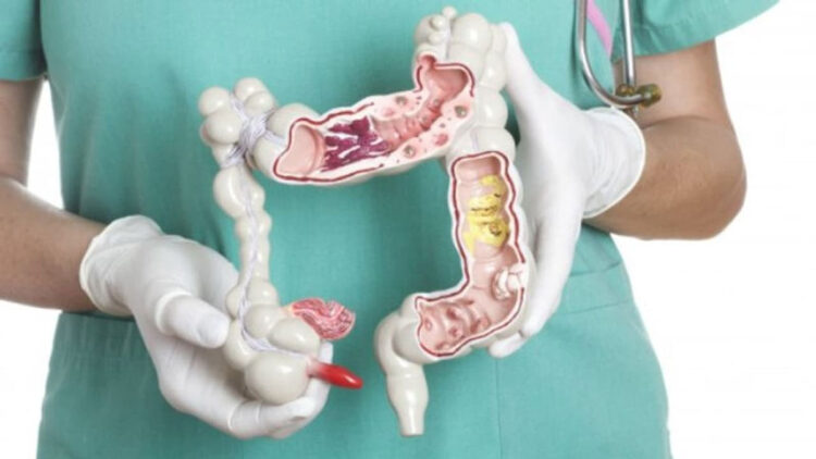വൻകുടൽ ക്യാൻസറിന്റെ പ്രധാനപ്പെട്ട ലക്ഷണങ്ങൾ