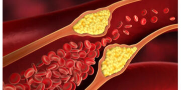 കൊളസ്ട്രോൾ രോഗികൾ ഡയറ്റിൽ നിന്നും ഒഴിവാക്കേണ്ട ഭക്ഷണങ്ങൾ