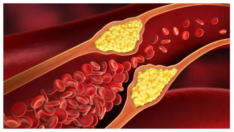 കൊളസ്ട്രോൾ രോഗികൾ ഡയറ്റിൽ നിന്നും ഒഴിവാക്കേണ്ട ഭക്ഷണങ്ങൾ