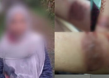 ഭിന്നശേഷിക്കാരിയായ യുവതിയുടെ കൈ ചൂടുവെള്ളം ഒഴിച്ച് പൊള്ളിച്ചു, അധ്യാപികയ്ക്കെതിരെ പരാതി