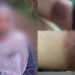 ഭിന്നശേഷിക്കാരിയായ യുവതിയുടെ കൈ ചൂടുവെള്ളം ഒഴിച്ച് പൊള്ളിച്ചു, അധ്യാപികയ്ക്കെതിരെ പരാതി