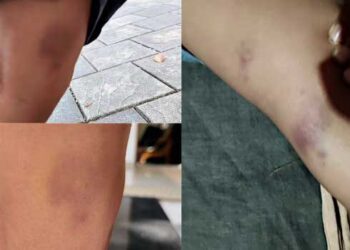 പഠിക്കാത്തതിന് കുരുന്നിനോട് അംഗൻവാടി ടീച്ചറുടെ ക്രൂരത!! നാലര വയസുകാരന്റെ രണ്ട് കാലിലെയും തുടയിൽ രക്തം കട്ടപിടിച്ച പാടുകൾ… ക്ഷമിക്കണമെന്ന് അംഗൻവാടി ടീച്ചർ, അക്ഷരം പഠിപ്പിക്കുന്നതിനിടെ സംഭവിച്ചത്- അധികൃതർ