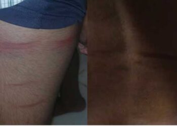 വിദ്യാർഥിയുടെ കാലിലും ദേഹത്തും അടികൊണ്ട് തിമിർത്ത പാടുകൾ, അവധിയെടുത്ത പത്താം ക്ലാസുകാരന് ക്ലാസ് ടീച്ചറിന്റെ ക്രൂര മർദനം,പോലീസിൽ പരാതി