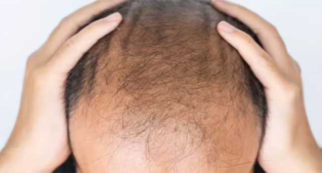 മുടി കൊഴിച്ചിൽ ഇനി ഒരു പ്രശ്നമേയല്ല, വെറും 20 ദിവസങ്ങൾക്കകം മുടി വളർത്താൻ കഴിയുന്ന പുതിയ സിറം വികസിപ്പിച്ചതായി തായ്വാൻ സർവകലാശാലയിലെ ഗവേഷകർ