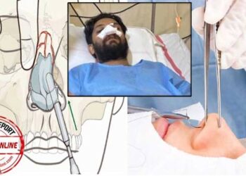 ഷാഫി പറമ്പിലിനു നടത്തിയത് നേസൽ ബോൺ ഫ്രാക്ച്ചർ റിഡക്ഷൻ, എൻഡോസ്കോപിക് സെപ്റ്റോപ്ലാസ്റ്റി സർജറികൾ, ഇതിന് താടിയോ, മുടിയോ നീക്കം ചെയ്യേണ്ട- ഷാഫിയുടെ ശസ്ത്രക്രിയ നടത്തിയ ഡോക്ടർമാർ പറയുന്നത്-  (വീഡിയോ)