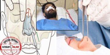 ഷാഫി പറമ്പിലിനു നടത്തിയത് നേസൽ ബോൺ ഫ്രാക്ച്ചർ റിഡക്ഷൻ, എൻഡോസ്കോപിക് സെപ്റ്റോപ്ലാസ്റ്റി സർജറികൾ, ഇതിന് താടിയോ, മുടിയോ നീക്കം ചെയ്യേണ്ട- ഷാഫിയുടെ ശസ്ത്രക്രിയ നടത്തിയ ഡോക്ടർമാർ പറയുന്നത്- (വീഡിയോ)