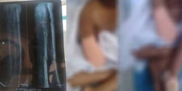 ‘സർക്കാരിൽ നിന്ന് നീതി കിട്ടിയില്ല, ആരും തിരിഞ്ഞുപോലും നോക്കിയില്ല’!! 9 വയസുകാരിയുടെ കൈ മുറിച്ചുമാറ്റിയ സംഭവത്തിൽ ഡോക്ടർമാർക്കെതിരെ നടപടി ആവശ്യപ്പെട്ട് പോലീസിൽ പരാതി നൽകി കുടുംബം