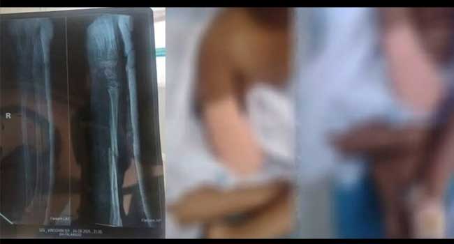 ‘സർക്കാരിൽ നിന്ന് നീതി കിട്ടിയില്ല, ആരും തിരിഞ്ഞുപോലും നോക്കിയില്ല’!! 9 വയസുകാരിയുടെ കൈ മുറിച്ചുമാറ്റിയ സംഭവത്തിൽ ഡോക്ടർമാർക്കെതിരെ നടപടി ആവശ്യപ്പെട്ട് പോലീസിൽ പരാതി നൽകി കുടുംബം