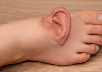 ലോകത്താദ്യം ഇത്തരമൊരു ശസ്ത്രക്രിയ!! ജോലി സ്ഥലത്തുവച്ച് യുവതിയുടെ ചെവിയും ശിരോചർമവും മെഷീൻ അറുത്തു, 5 മാസങ്ങൾക്കിപ്പുറം ‘ജീവനോടെ’യിരിക്കാൻ കാലിൽ തുന്നിച്ചേർത്ത ചെവിയെടുത്ത് യഥാസ്ഥാനത്ത് വച്ച് ചൈനയിലെ ഡോക്ടർമാർ