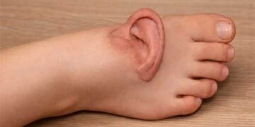 ലോകത്താദ്യം ഇത്തരമൊരു ശസ്ത്രക്രിയ!! ജോലി സ്ഥലത്തുവച്ച് യുവതിയുടെ ചെവിയും ശിരോചർമവും മെഷീൻ അറുത്തു, 5 മാസങ്ങൾക്കിപ്പുറം ‘ജീവനോടെ’യിരിക്കാൻ കാലിൽ തുന്നിച്ചേർത്ത ചെവിയെടുത്ത് യഥാസ്ഥാനത്ത് വച്ച് ചൈനയിലെ ഡോക്ടർമാർ