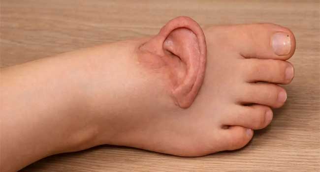 ലോകത്താദ്യം ഇത്തരമൊരു ശസ്ത്രക്രിയ!! ജോലി സ്ഥലത്തുവച്ച് യുവതിയുടെ ചെവിയും ശിരോചർമവും മെഷീൻ അറുത്തു, 5 മാസങ്ങൾക്കിപ്പുറം ‘ജീവനോടെ’യിരിക്കാൻ കാലിൽ തുന്നിച്ചേർത്ത ചെവിയെടുത്ത് യഥാസ്ഥാനത്ത് വച്ച് ചൈനയിലെ ഡോക്ടർമാർ