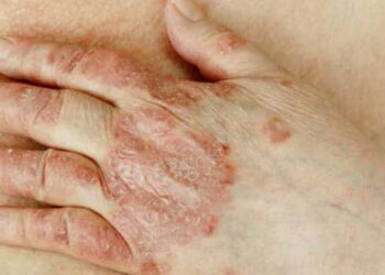 ത്വക്കിലുണ്ടാകുന്ന എല്ലാ പാടുകളും ചുണങ്ങെന്നു കരുതി അവ​ഗണിക്കല്ലേ…വിട്ടൊഴിഞ്ഞെന്നു കരുതിയ മാരക രോ​ഗം കേരളത്തിൽ വീണ്ടും …179 പേർക്ക് പുതുതായി കുഷ്ഠരോ​ഗബാധ!