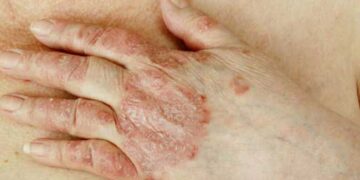 ത്വക്കിലുണ്ടാകുന്ന എല്ലാ പാടുകളും ചുണങ്ങെന്നു കരുതി അവ​ഗണിക്കല്ലേ…വിട്ടൊഴിഞ്ഞെന്നു കരുതിയ മാരക രോ​ഗം കേരളത്തിൽ വീണ്ടും …179 പേർക്ക് പുതുതായി കുഷ്ഠരോ​ഗബാധ!