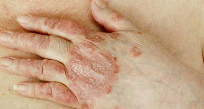 ത്വക്കിലുണ്ടാകുന്ന എല്ലാ പാടുകളും ചുണങ്ങെന്നു കരുതി അവ​ഗണിക്കല്ലേ…വിട്ടൊഴിഞ്ഞെന്നു കരുതിയ മാരക രോ​ഗം കേരളത്തിൽ വീണ്ടും …179 പേർക്ക് പുതുതായി കുഷ്ഠരോ​ഗബാധ!