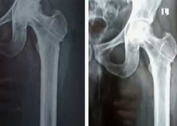 രക്തയോട്ടം കൂട്ടാനുള്ള ശസ്ത്രക്രിയക്കിടെ ഡ്രിൽ ബിറ്റ് ഒടിഞ്ഞു ഇടുപ്പ് എല്ലിൽ കയറി, ലോഹ കഷണം നീക്കം ചെയ്യാനാകില്ല, അത് അങ്ങനെ ഇരിക്കുന്നതുകൊണ്ട് പ്രശ്നങ്ങളുണ്ടാകില്ല, ആശുപത്രി അധികൃതരുടെ വിശദീകരണം!! തിരുവനന്തപുരം ജൂബിലി മെമ്മോറിയൽ ആശുപത്രിയിൽ ​ഗുരുതര ചികിത്സാ പിഴവ്, കേസ്