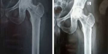 രക്തയോട്ടം കൂട്ടാനുള്ള ശസ്ത്രക്രിയക്കിടെ ഡ്രിൽ ബിറ്റ് ഒടിഞ്ഞു ഇടുപ്പ് എല്ലിൽ കയറി, ലോഹ കഷണം നീക്കം ചെയ്യാനാകില്ല, അത് അങ്ങനെ ഇരിക്കുന്നതുകൊണ്ട് പ്രശ്നങ്ങളുണ്ടാകില്ല, ആശുപത്രി അധികൃതരുടെ വിശദീകരണം!! തിരുവനന്തപുരം ജൂബിലി മെമ്മോറിയൽ ആശുപത്രിയിൽ ​ഗുരുതര ചികിത്സാ പിഴവ്, കേസ്