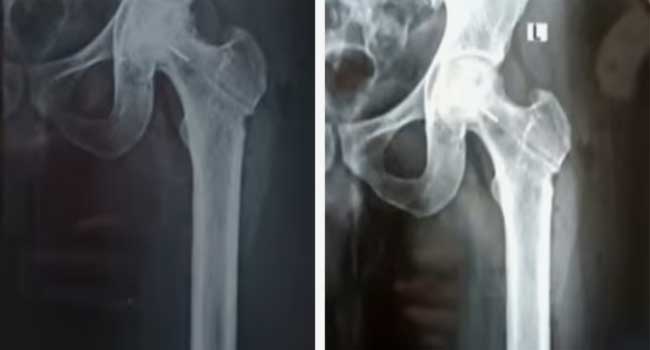 രക്തയോട്ടം കൂട്ടാനുള്ള ശസ്ത്രക്രിയക്കിടെ ഡ്രിൽ ബിറ്റ് ഒടിഞ്ഞു ഇടുപ്പ് എല്ലിൽ കയറി, ലോഹ കഷണം നീക്കം ചെയ്യാനാകില്ല, അത് അങ്ങനെ ഇരിക്കുന്നതുകൊണ്ട് പ്രശ്നങ്ങളുണ്ടാകില്ല, ആശുപത്രി അധികൃതരുടെ വിശദീകരണം!! തിരുവനന്തപുരം ജൂബിലി മെമ്മോറിയൽ ആശുപത്രിയിൽ ​ഗുരുതര ചികിത്സാ പിഴവ്, കേസ്