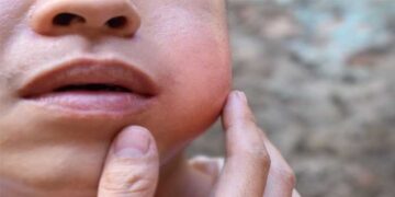 സൗജന്യ വാക്സിൻ വിതരണം നിലച്ചു, ചെലവ് സംസ്ഥാനം വഹിക്കില്ല, പകരം കേന്ദ്രം തരണം!! മുണ്ടിനീര് വ്യാപനം തടയാൻ ആരോഗ്യ വകുപ്പിന് വേറെ വഴിയില്ല, മാരാരിക്കുളം ഗവ. എൽ.പി സ്കൂൾ താത്കാലികമായി അടച്ചു, ക്ലാസുകൾ ഇനി ഓൺലൈനായി…വാക്സിൻ നൽകിയില്ലെങ്കിൽ സ്ഥിതി രൂക്ഷമാകും- ആരോഗ്യപ്രവർത്തകർ, രോഗംതടയാൻ തെക്കൻ മേഖലയിലെ അടച്ചുപൂട്ടിയത് 38 വിദ്യാഭ്യാസസ്ഥാപനങ്ങൾ