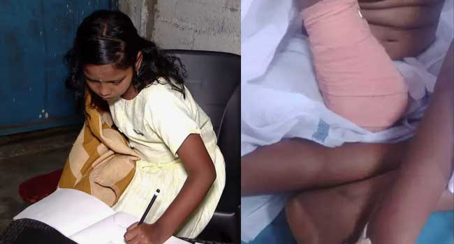 അവൾ എഴുതി പഠിക്കുവാണ് ഇടതു കൈകൊണ്ട്, ഡോക്ടറുടെ അനാസ്ഥയിൽ വലതു കൈ നഷ്ടപ്പെട്ട കുഞ്ഞു വിനോദിനിക്ക് പുതുവർഷത്തിലും സ്കൂളിൽ പോകാനായിട്ടില്ല, മുറുച്ചുമാറ്റിയ വലതു കൈയ്ക്ക് പകരം കൃത്രിമ കൈ വയ്ക്കാൻ സർക്കാർ പ്രഖ്യാപിച്ച 2 ലക്ഷം അപര്യാപ്തം, മറ്റു സാമ്പത്തികമില്ല… കലക്ടറെ കണ്ട് പരാതി അറിയിച്ചിട്ടുണ്ടെന്ന് കുടുംബം