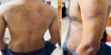 ലൈംഗികബന്ധത്തിൽ ഏർപ്പെടാൻ വിസമ്മതിച്ചു, ബധിരനും മൂകനുമായ യുവാവിന് ക്രൂര മർദനം, ലോഡ്ജിലെത്തിച്ചത് സുഹൃത്തായ യുവതി