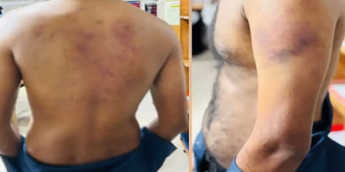 ലൈംഗികബന്ധത്തിൽ ഏർപ്പെടാൻ വിസമ്മതിച്ചു, ബധിരനും മൂകനുമായ യുവാവിന് ക്രൂര മർദനം, ലോഡ്ജിലെത്തിച്ചത് സുഹൃത്തായ യുവതി