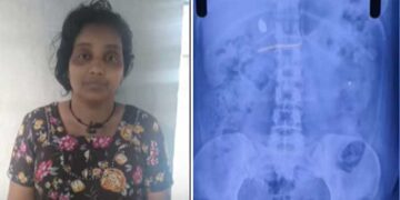 ‘തൊണ്ടിമുതലും ദൃക്സാക്ഷിയു’മായി കേരളാ പോലീസും സമീനയും!! ക്ലിനിക്കിലെത്തിയ കുട്ടിയു‌ടെ 3.5 ​ഗ്രാം വരുന്ന സ്വർണമാല അടിച്ചുമാറ്റി വിഴുങ്ങി, എടുത്തിട്ടില്ലെന്ന് യുവതി, എക്സറേയിൽ സ്വർണം വയറ്റിലുണ്ടെന്ന് കണ്ടെത്തൽ, യുവതിക്ക് എനിമ വച്ച് തൊണ്ടിമുതലിനായുള്ള വനിതാ പോലീസിന്റെ കാത്തിരിപ്പ് മൂന്നാം ദിവസത്തിലേക്ക്…