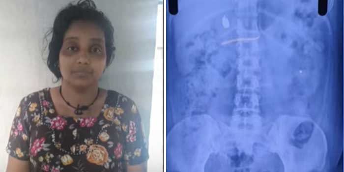 ‘തൊണ്ടിമുതലും ദൃക്സാക്ഷിയു’മായി കേരളാ പോലീസും സമീനയും!! ക്ലിനിക്കിലെത്തിയ കുട്ടിയു‌ടെ 3.5 ​ഗ്രാം വരുന്ന സ്വർണമാല അടിച്ചുമാറ്റി വിഴുങ്ങി, എടുത്തിട്ടില്ലെന്ന് യുവതി, എക്സറേയിൽ സ്വർണം വയറ്റിലുണ്ടെന്ന് കണ്ടെത്തൽ, യുവതിക്ക് എനിമ വച്ച് തൊണ്ടിമുതലിനായുള്ള വനിതാ പോലീസിന്റെ കാത്തിരിപ്പ് മൂന്നാം ദിവസത്തിലേക്ക്…