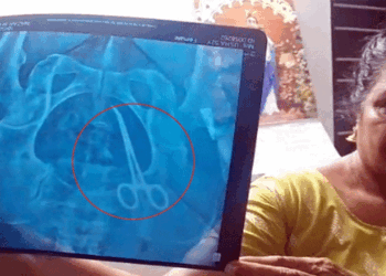 ശസ്ത്രക്രിയയ്ക്ക് വിധേയയായ വീട്ടമ്മയുടെ വയറ്റിൽ കത്രിക; ദുരിത വേദന പേറാൻ തുടങ്ങിയിട്ട് അഞ്ച് വർഷം; വണ്ടാനം മെഡിക്കൽ കോളേജിനെതിരെ ​ഗുരുതര ആരോപണം