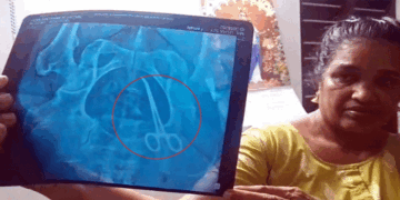 ശസ്ത്രക്രിയയ്ക്ക് വിധേയയായ വീട്ടമ്മയുടെ വയറ്റിൽ കത്രിക; ദുരിത വേദന പേറാൻ തുടങ്ങിയിട്ട് അഞ്ച് വർഷം; വണ്ടാനം മെഡിക്കൽ കോളേജിനെതിരെ ​ഗുരുതര ആരോപണം