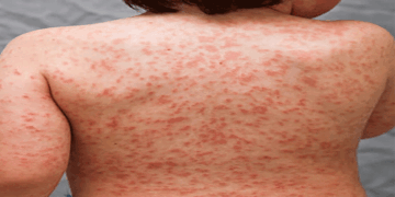 കട്ടപ്പനയിൽ ഒന്നരവയസുകാരിയ്ക്ക് അപൂർവവും ​ഗുരുതരവുമായ  കവാസാക്കി രോഗം സ്ഥിരീകരിച്ചു