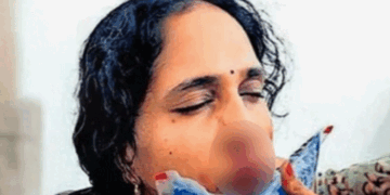 ക്ലാസിനിടെ ​ഗെയിം കളിക്കരുതെന്ന് പറഞ്ഞു; വിദ്യാർത്ഥി അധ്യാപികയെ ആക്രമിച്ചു; ​ഗുരുതര പരിക്ക്; മൂക്കിന്റെ എല്ല് തകർന്നു