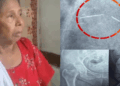 ‘ശരീരത്തിൽ പകുതി സൂചി കുടുങ്ങിയ നിലയിലാണ് വത്സലയെ ഡിസ്ചാർജ്  ചെയ്തെന്നത് ഡോക്ടറുടെ വീഴ്ച; എന്നാൽ അത് കോഴഞ്ചേരി ജില്ല ആശുപത്രിയിൽ നിന്നും കുത്തിവച്ച സൂചിയാണെന്നതിന് തെളിവില്ല‘- ചികിത്സ പിഴവ് പരാതിയിൽ അന്വേഷണ റിപ്പോർട്ട്