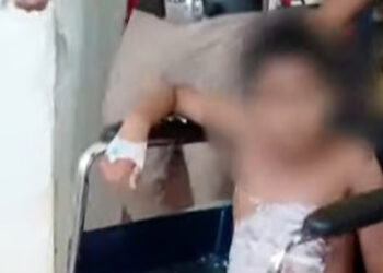 അച്ഛന്‍ പൊള്ളിച്ചതാ… ദേഹമാസകലം പൊള്ളലേറ്റ് പത്തുവയസുകാരന്‍, ചൂടുവെള്ളം വീണതാണെന്ന് ബന്ധുക്കള്‍