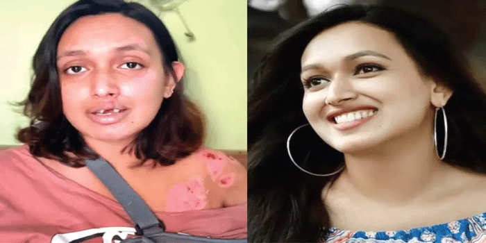 ‘ശരീരം മുഴുവൻ എല്ലുനുറുങ്ങും വേദനയാണ്; കണ്ണടയ്ക്കുമ്പോൾ പേടി ഇരച്ചെത്തും; ആഹാരം കഴിക്കാൻ കഴിയുന്നില്ല; കണ്ണാടിയിൽ നോക്കുമ്പോൾ ഞാനറിയുന്ന ഞാനല്ല മുന്നിൽ…’; റാപ്പിഡോ അപകടത്തിൽ തകർന്ന സാനി കൃഷ്ണ
