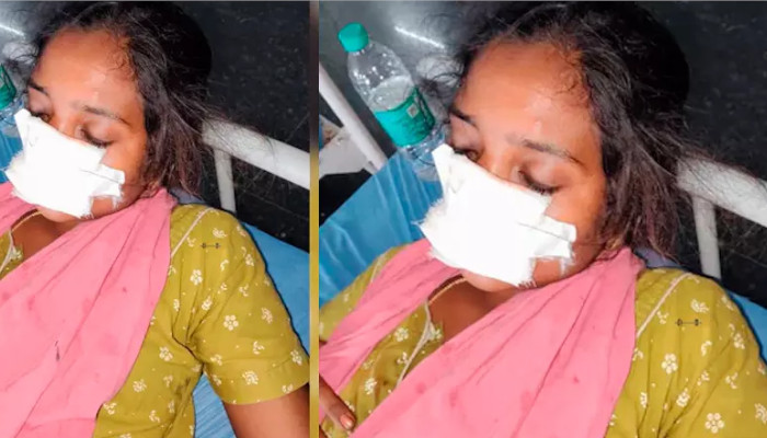 ഭര്ത്താവിനോട് വഴക്കിട്ട് സ്വന്തം വീട്ടിലേക്ക് പോയി, എത്ര വിളിച്ചിട്ടും തിരിച്ചു വന്നില്ല, ദേഷ്യം സഹിക്കാനാകാതെ ഭാര്യയുടെ മൂക്ക് കടിച്ചുമുറിച്ച് യുവാവ്, ഭാര്യാ പിതാവിനും മര്ദനം